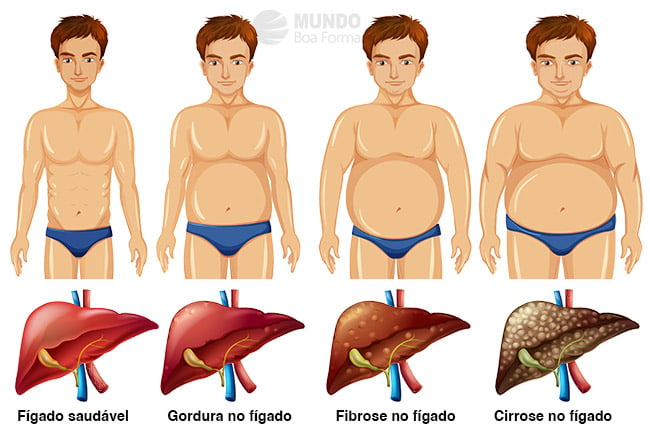 Dieta para esteatose hepática - Alimentos, cardápio e dicas - MundoBoaForma - cardápio de dieta para gordura no fígado pdf