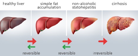Dieta com cardápio para gordura no fígado (esteatose hepática)