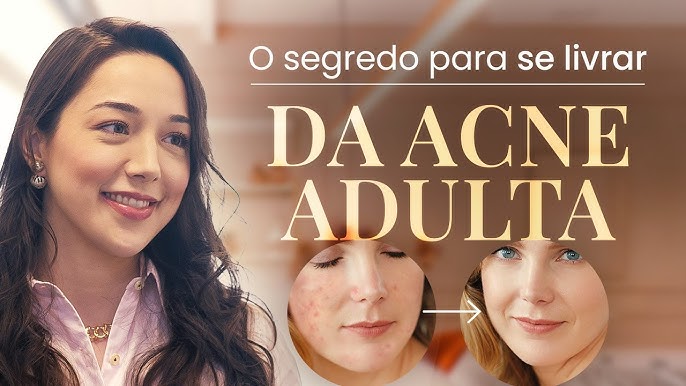 como acabar com a acne adulta