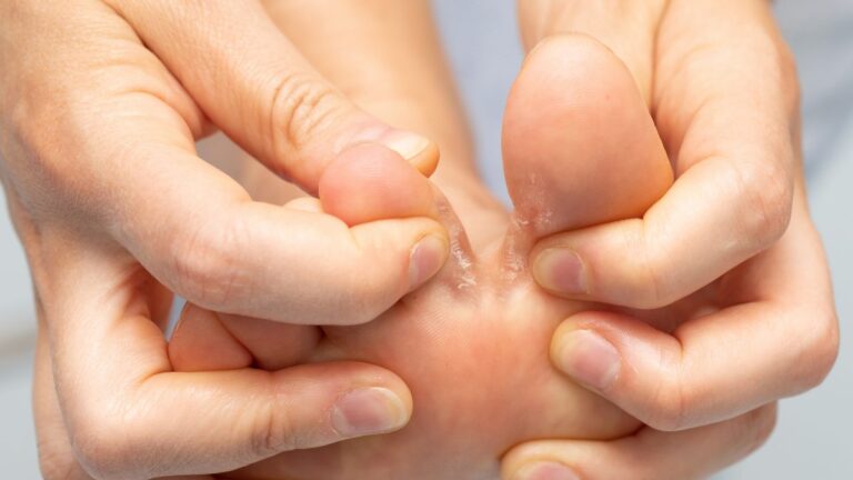 como acabar com a frieira rapido